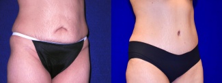 Right 3/4 View - Tummy Tuck