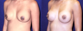 Left 3/4 View - Breast Implant Revision