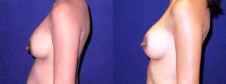 Left Profile View - Breast Implant Revision