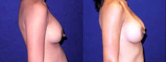 Right Profile View - Breast Implant Revision