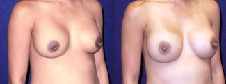 Right 3/4 View - Breast Implant Revision