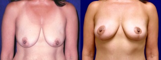 Frontal View - Breast Lift