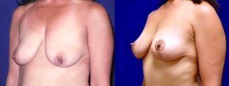 Left 3/4 View - Breast Lift