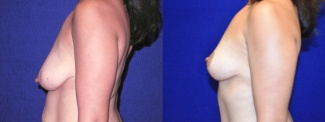 Left Profile View - Breast Lift