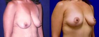 Right 3/4 View - Breast Lift