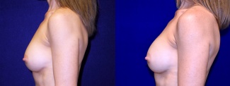 Left Profile View - Breast Implant Revision