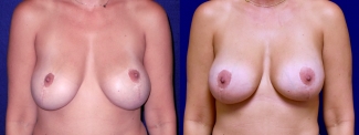 Frontal View - Breast Implant Revision