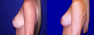 Left Profile View - Breast Implant Revision