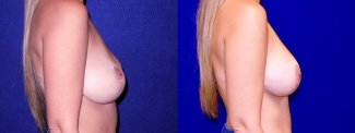 Right Profile View - Breast Implant Revision