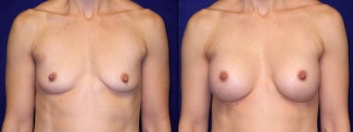 Frontal View - Breast Augmentation