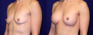 Left 3/4 View - Breast Augmentation