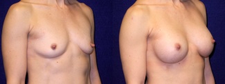 Right 3/4 View - Breast Augmentation