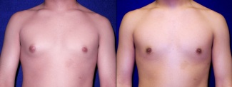 Frontal View - Gynecomastia