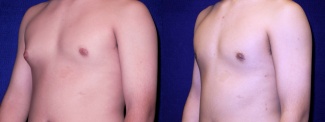 Left 3/4 View - Gynecomastia