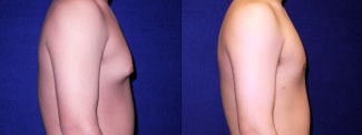 Right Profile View - Gynecomastia