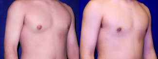 Right 3/4 View - Gynecomastia