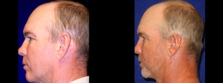 Left Profile View - Otoplasty