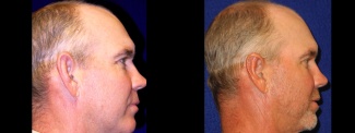 Right Profile View - Otoplasty