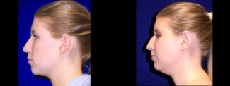 Left Profile View - Otoplasty