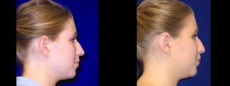 Right Profile View - Otoplasty