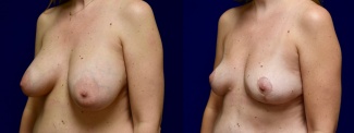 Left 3/4 View - Breast Implant Removal with Breast Lift