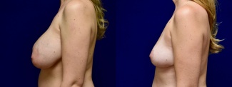 Left Profile View - Breast Implant Removal with Breast Lift