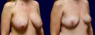Right 3/4 View - Breast Implant Removal with Breast Lift