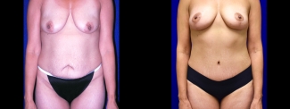 Frontal View - Tummy Tuck with Breast Lift