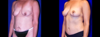 Left 3/4 View - Tummy Tuck with Breast Lift