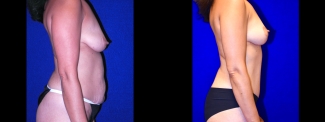 Right Profile View - Tummy Tuck with Breast Lift