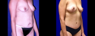 Right 3/4 View - Tummy Tuck with Breast Lift