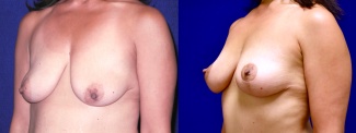 Left 3/4 View - Breast Lift