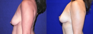 Left Profile View - Breast Lift