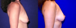 Right Profile View - Breast Lift