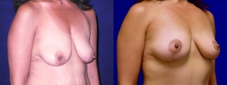 Right 3/4 View - Breast Lift