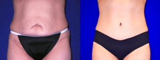 Frontal View - Tummy Tuck