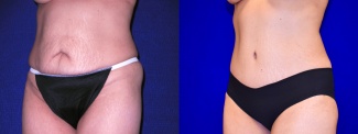 Left 3/4 View - Tummy Tuck