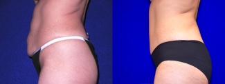 Left Profile View - Tummy Tuck