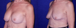 Left 3/4 View - Breast Implant Removal