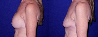 Left Profile View - Breast Implant Removal