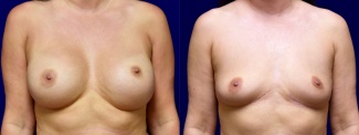 Frontal View - Breast Implant Removal