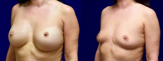 Left 3/4 View - Breast Implant Removal