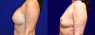 Left Profile View - Breast Implant Removal