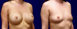 Right 3/4 View - Breast Implant Removal