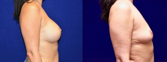 Right Profile View - Breast Implant Removal