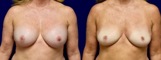 Frontal View - Breast Implant Removal