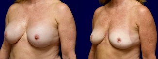 Left 3/4 View - Breast Implant Removal