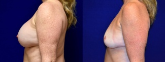 Left Profile View - Breast Implant Removal