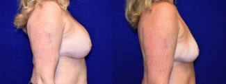 Right Profile View - Breast Implant Removal