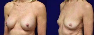 Left 3/4 View - Breast Implant Removal